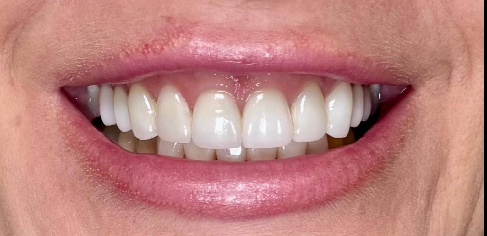 After dental treatment