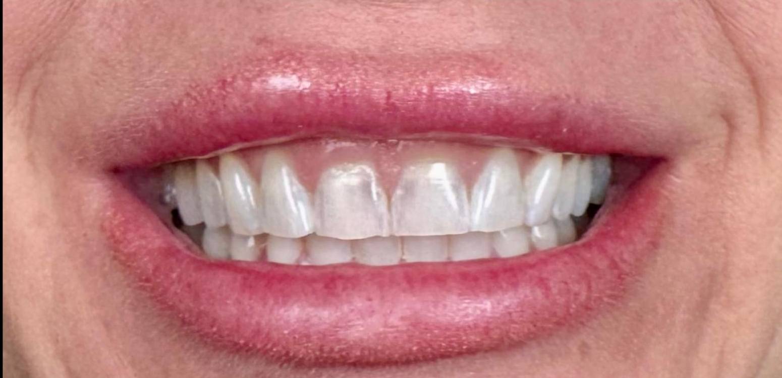 Before dental treatment